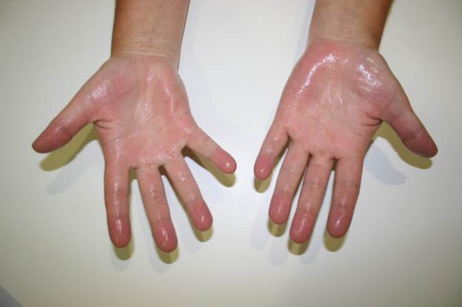 Hyperhidrose übermäßiges Schwitzen Thoraxchirurgie Uniklinikum